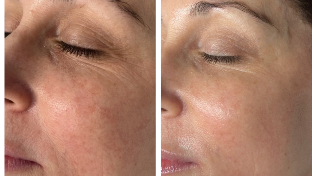 XĒRF in Charlotte: Non-Surgical Face & Neck Lifting at Avi Aesthetics