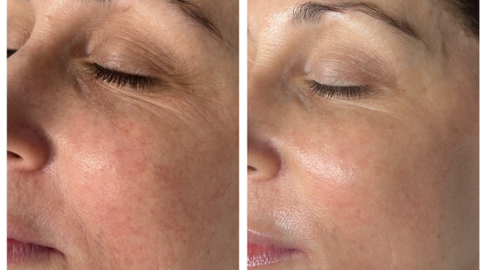 XĒRF in Charlotte: Non-Surgical Face & Neck Lifting at Avi Aesthetics